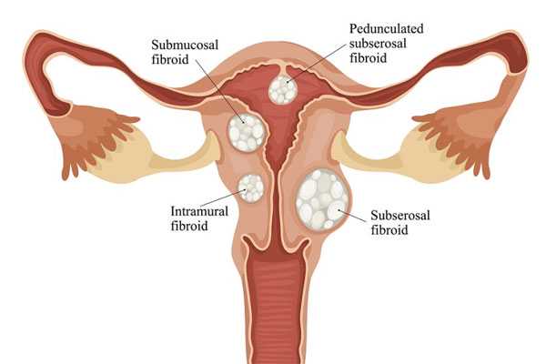 代生要多少钱-子宫腺肌症合并有子宫肌瘤该怎么办？